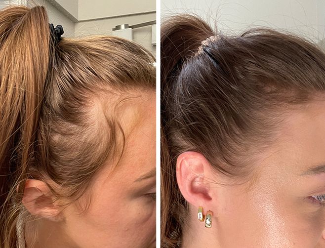 Cum Oprești Căderea Părului Natural: Ghid Complet pentru Femei