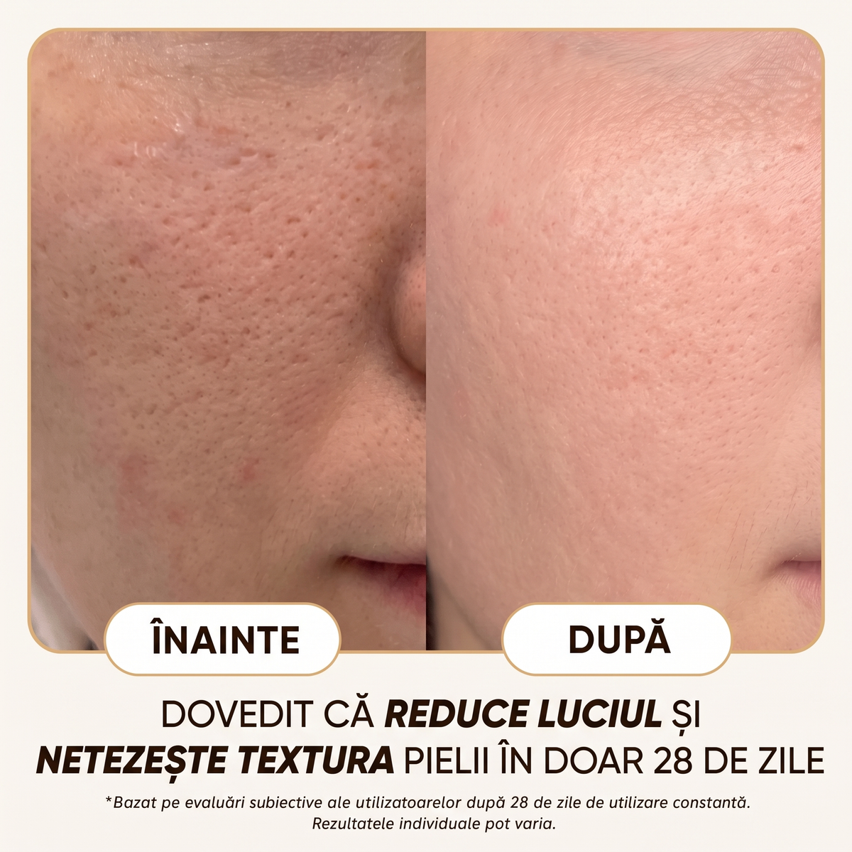 Crema Naturala Ten Gras & Acneic